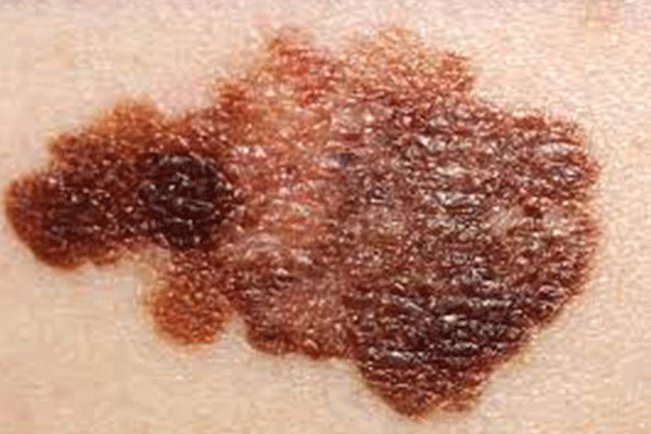 How to check for Melanoma