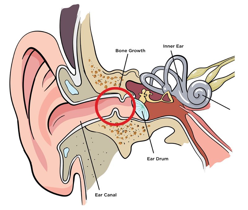What Is Exostosis (Surfers Ear)